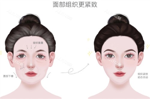 耳基底填充前后对比 耳基底填充前后对比