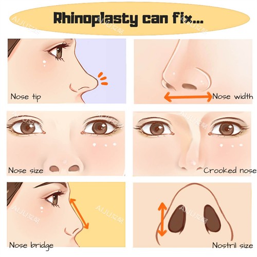 鼻修复流程一览图 鼻修复流程一览图