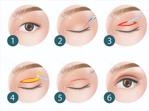 双眼皮步骤 双眼皮步骤