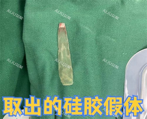 取出的硅胶假体照片 取出的硅胶假体照片