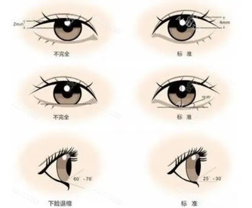 双眼皮对比图 双眼皮对比图