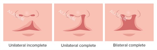 唇裂和唇腭裂不同程度