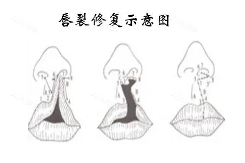 唇裂修复示意图.webp