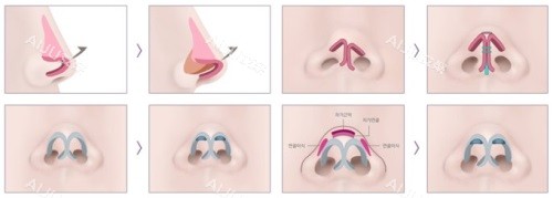 鼻修复示意图 鼻修复示意图