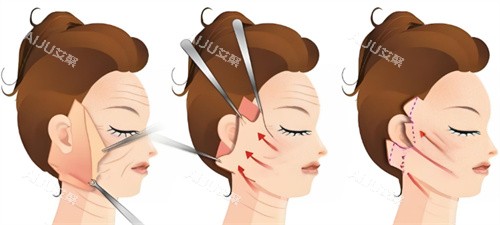 拉皮手术过程图 拉皮手术过程图