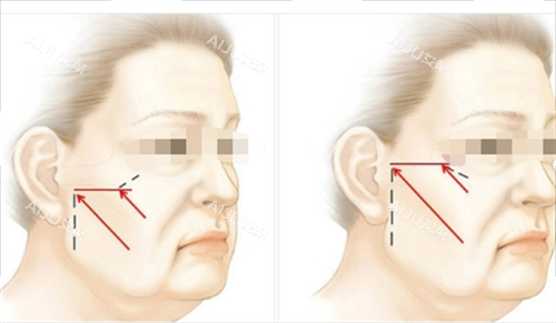 中上面部拉皮提拉方向画线图 中上面部拉皮提拉方向画线图