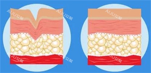爱塑美童颜针注射前后对比图 爱塑美童颜针注射前后对比图