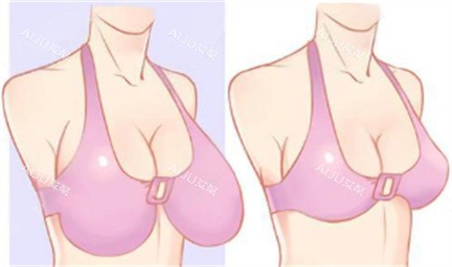 巨乳缩小术 巨乳缩小术