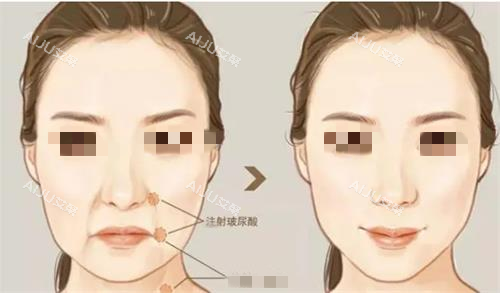注射玻尿酸前后对比图 注射玻尿酸前后对比图