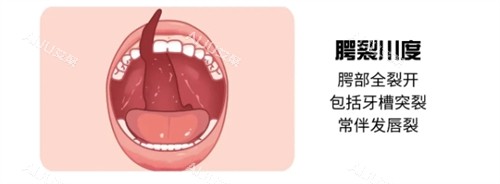 三度唇腭裂 三度唇腭裂