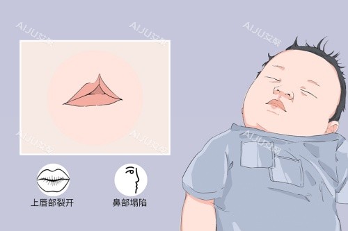 唇腭裂症状图 唇腭裂症状图