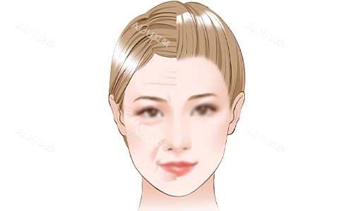 面部抗衰老的意义 面部抗衰老的意义
