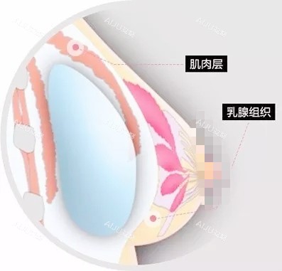 双平面丰胸 双平面丰胸