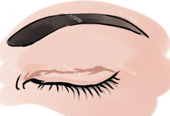 眼角增生疤痕动画展示图 眼角增生疤痕动画展示图