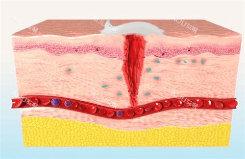 生长因子可以促进皮肤疤痕修复 生长因子可以促进皮肤疤痕修复
