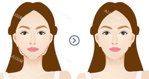 面部提升前后对比 面部提升前后对比