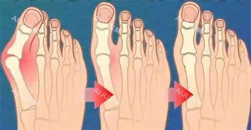 不同程度的大脚骨 不同程度的大脚骨