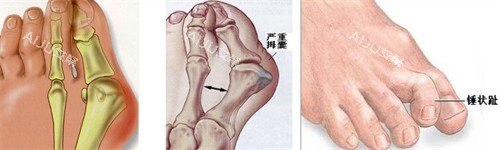大脚骨的表现 大脚骨的表现