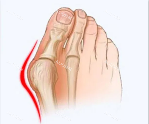大脚骨图片 大脚骨图片