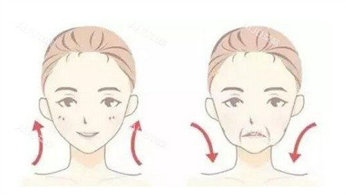 面部提升 面部提升