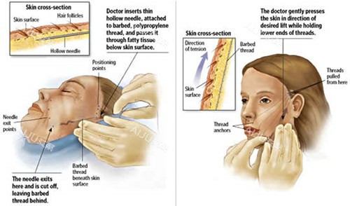 面部提升图片对比 面部提升图片对比