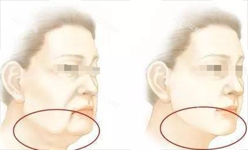 微拉美面部提升动画前后对比图 微拉美面部提升动画前后对比图