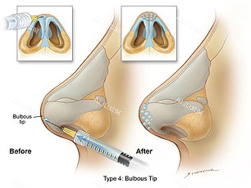 玻尿酸注射鼻尖 玻尿酸注射鼻尖