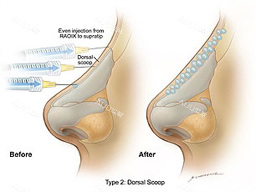 玻尿酸注射鼻背 玻尿酸注射鼻背