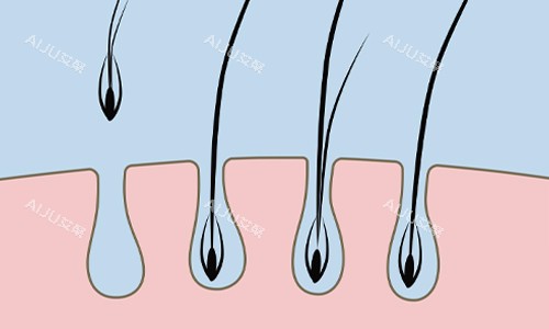 单毛囊植发展示 单毛囊植发展示