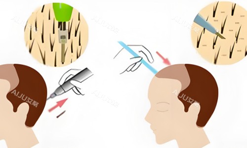 后枕部位取毛囊植发展示 后枕部位取毛囊植发展示