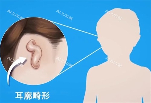 耳廓畸形