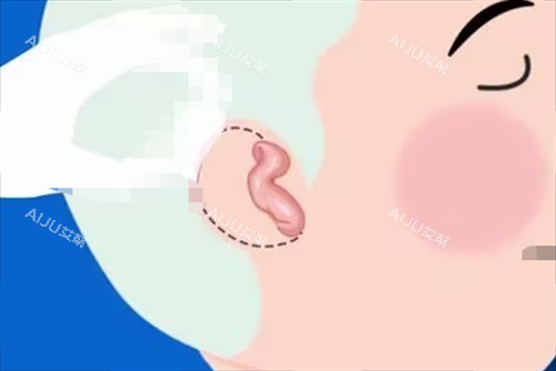 儿童耳再造耳畸形展示