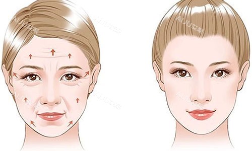 拉皮手术前后对比图 拉皮手术前后对比图