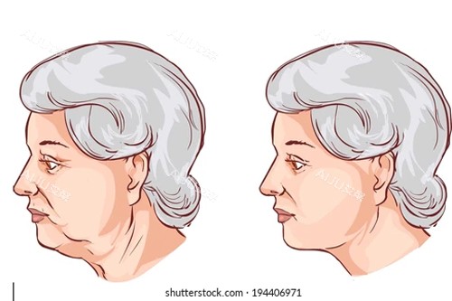 颈部拉皮卡通图 颈部拉皮卡通图