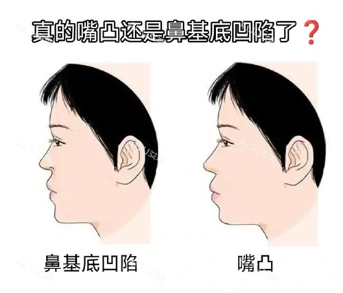 鼻基底凹和嘴凸