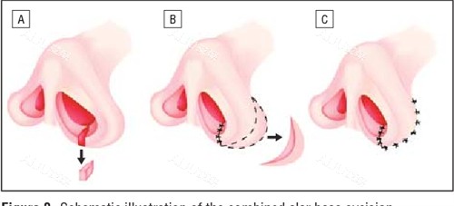鼻翼缩小流程图一览