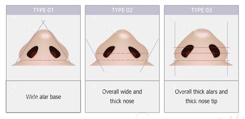 鼻翼缩小的流程图