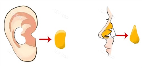 隆鼻耳软骨图示