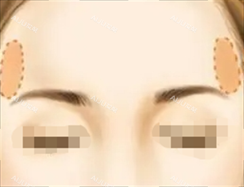 面部脂肪填充丰太阳穴动画展示图 面部脂肪填充丰太阳穴动画展示图
