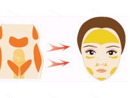 脸部脂肪填充图片 脸部脂肪填充图片