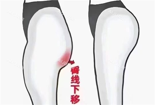 臀部脂肪填充对比 臀部脂肪填充对比