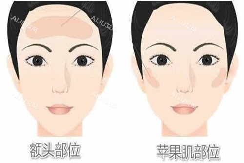 脂肪填充部位展示图 脂肪填充部位展示图