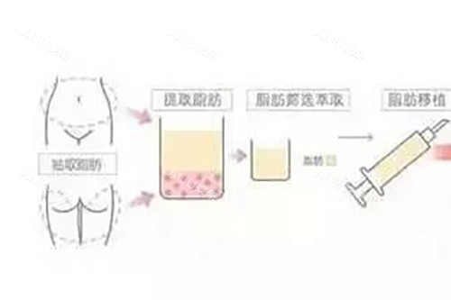 脂肪填充过程示意图 脂肪填充过程示意图
