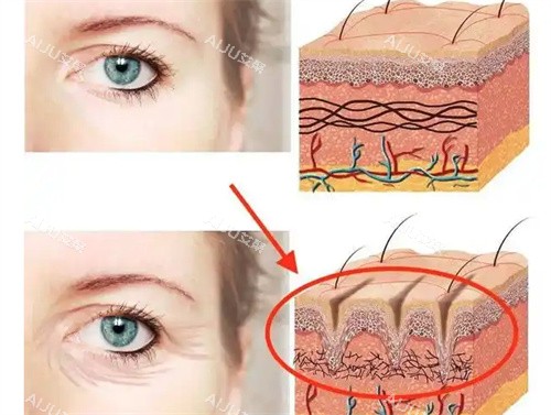 眼周筋膜提升前后 眼周筋膜提升前后