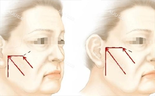 微拉美面部提升方向 微拉美面部提升方向