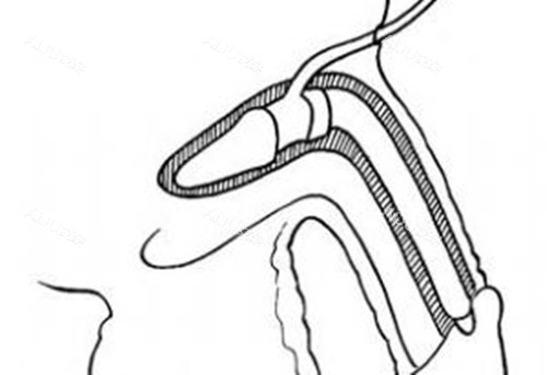 男性私密整形假体植入阴茎卡通示意图 男性私密整形假体植入阴茎卡通示意图