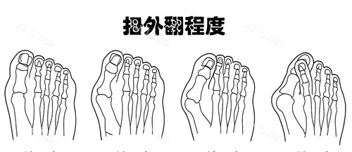 大脚骨外翻程度 大脚骨外翻程度