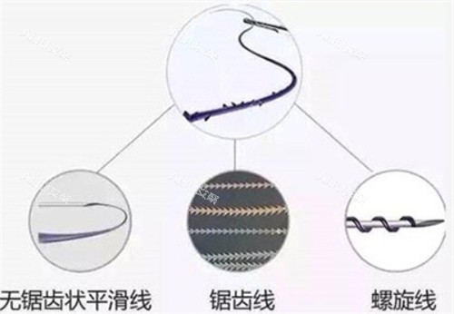 埋线提升不同类型的线 埋线提升不同类型的线