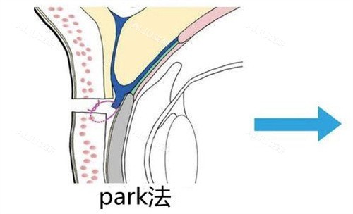 Park法双眼皮 Park法双眼皮