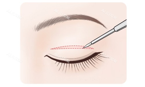 全切双眼皮切口展示 全切双眼皮切口展示